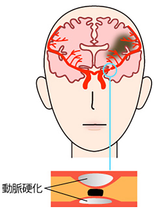 アテローム血栓性脳梗塞